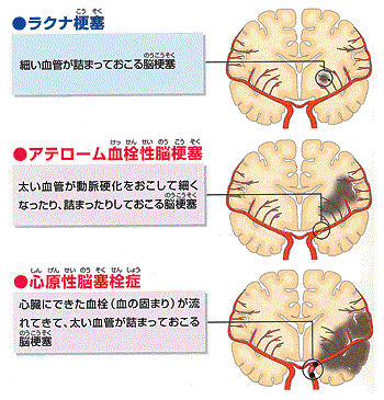 アテローム 血栓 性 脳 梗塞